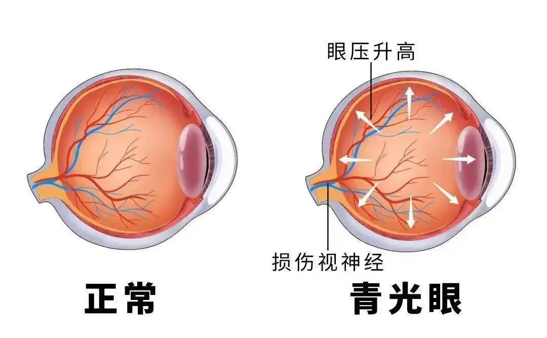 玩手机游戏时间长了眼睛痛_眼睛疼玩手机玩的_长时间玩手机眼睛疼用什么眼药